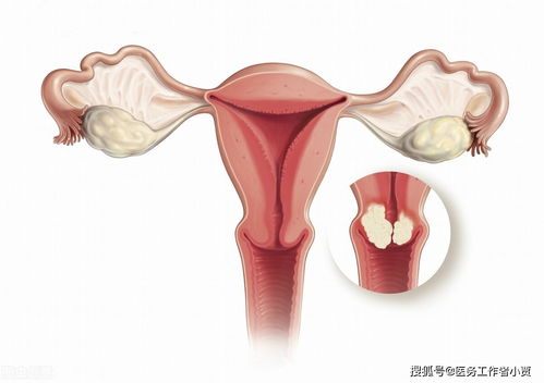 宫颈癌早期症状