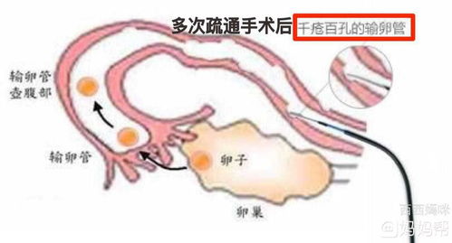 输卵管堵塞怎么治疗最好的方法